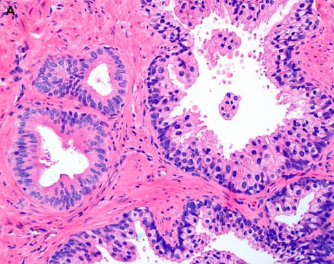 Uropathology